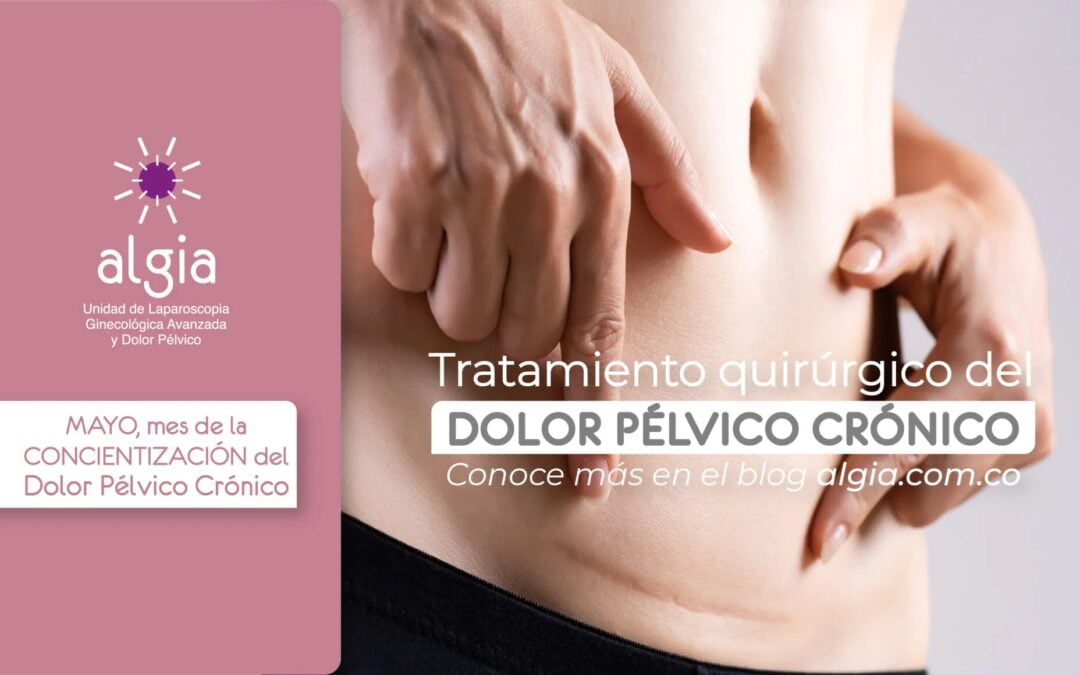 Tratamiento quirúrgico del Dolor Pélvico Crónico